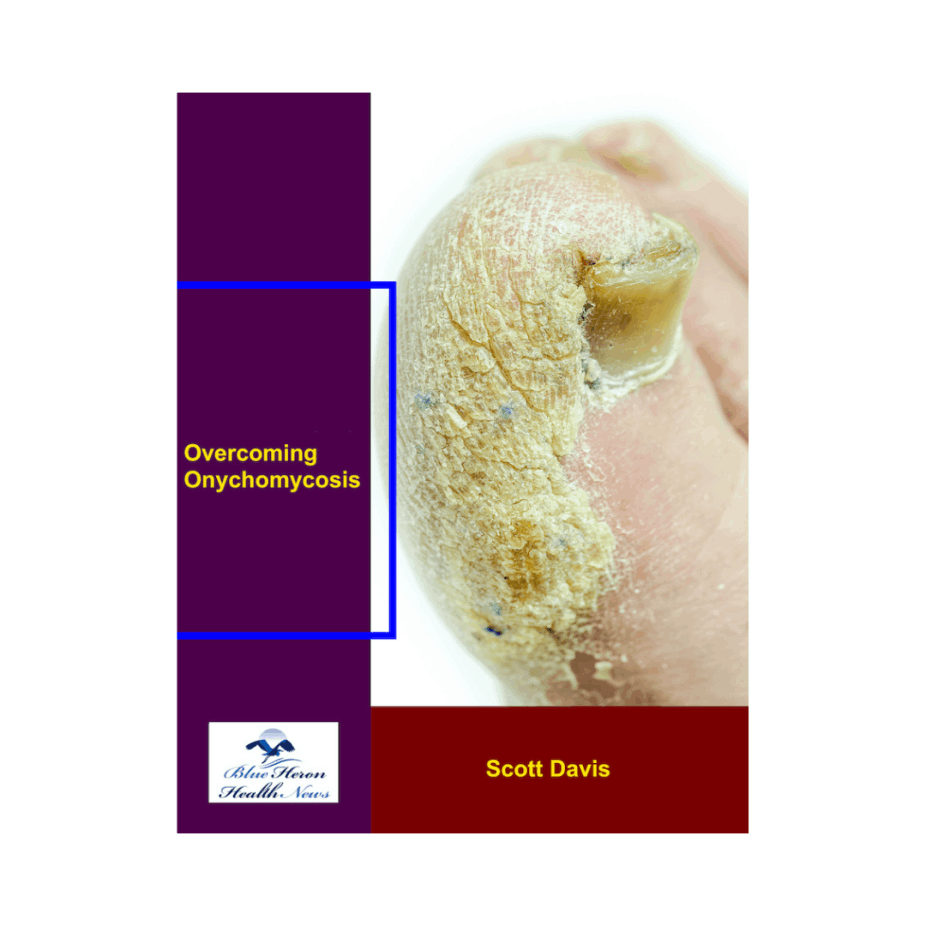 Overcoming Onychomycosis