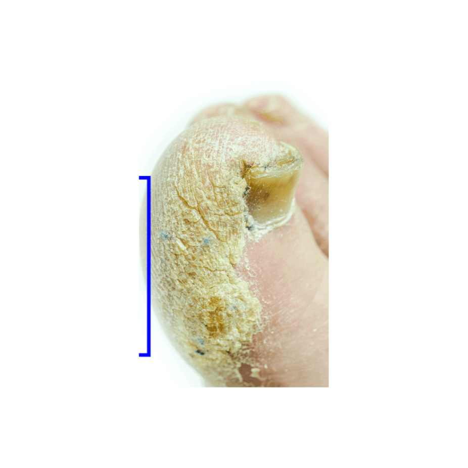 Overcoming Onychomycosis